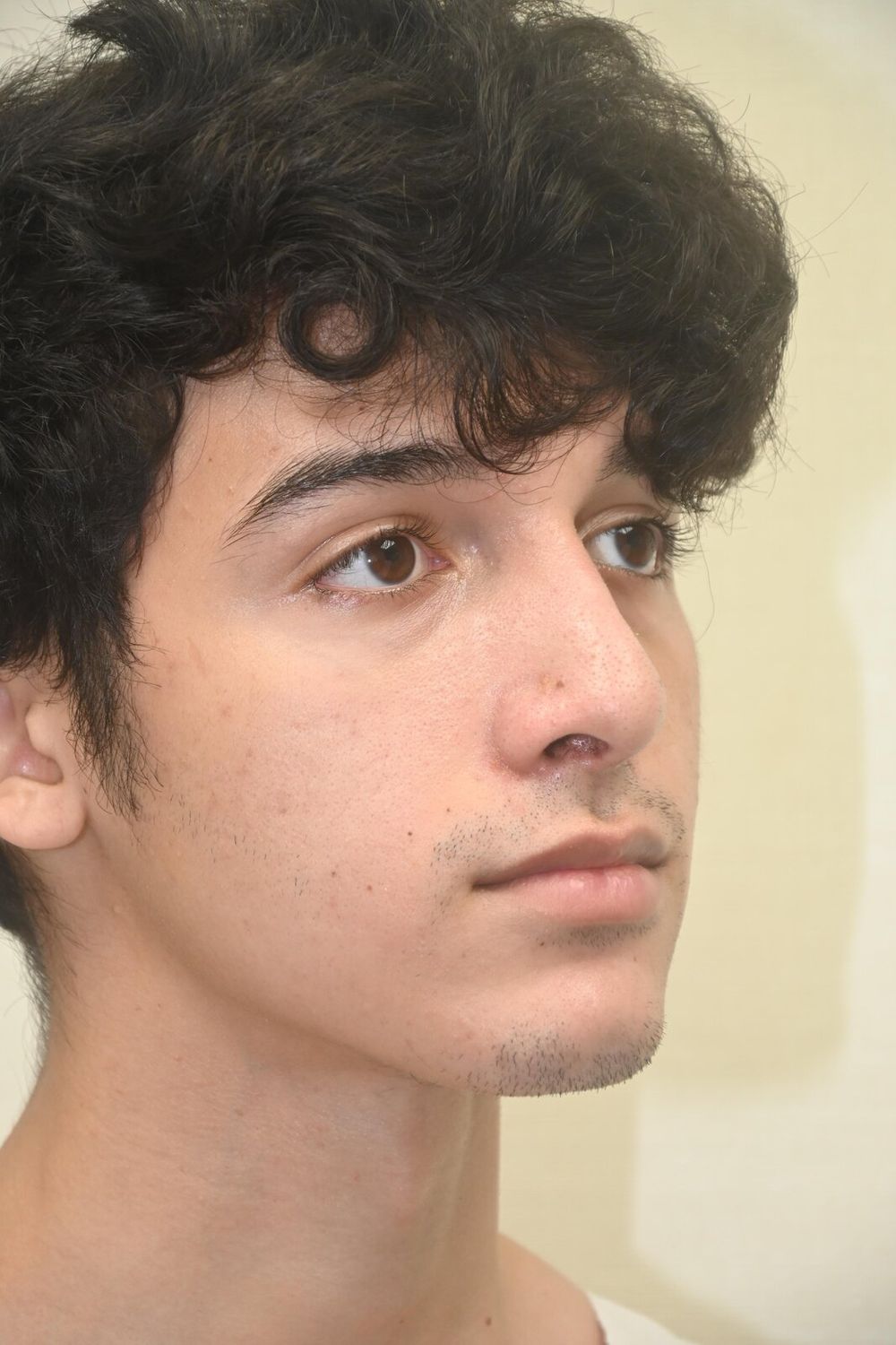 Rinoplastia Before & After