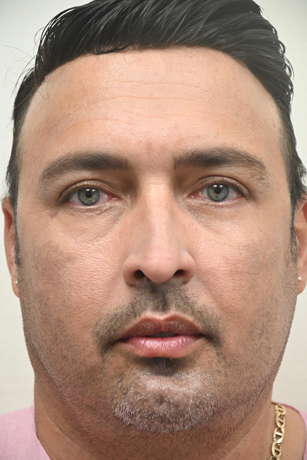 Rinoplastia Before & After