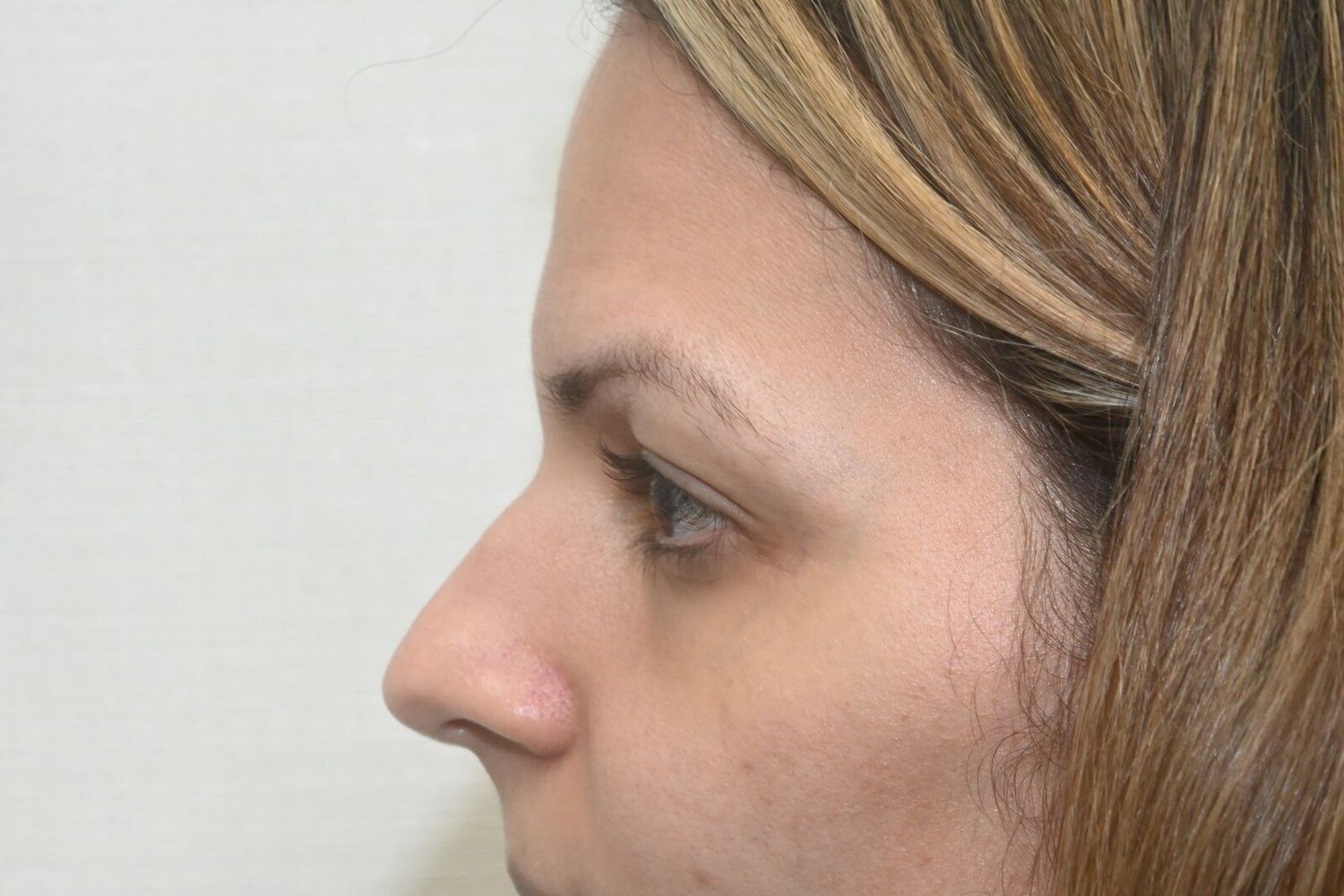 Rinoplastia Before & After