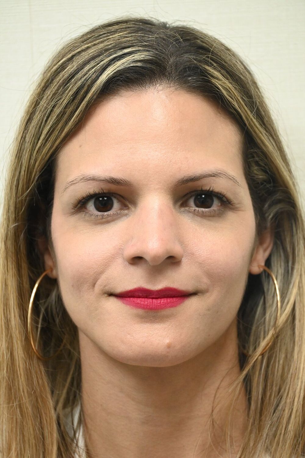 Rinoplastia Before & After