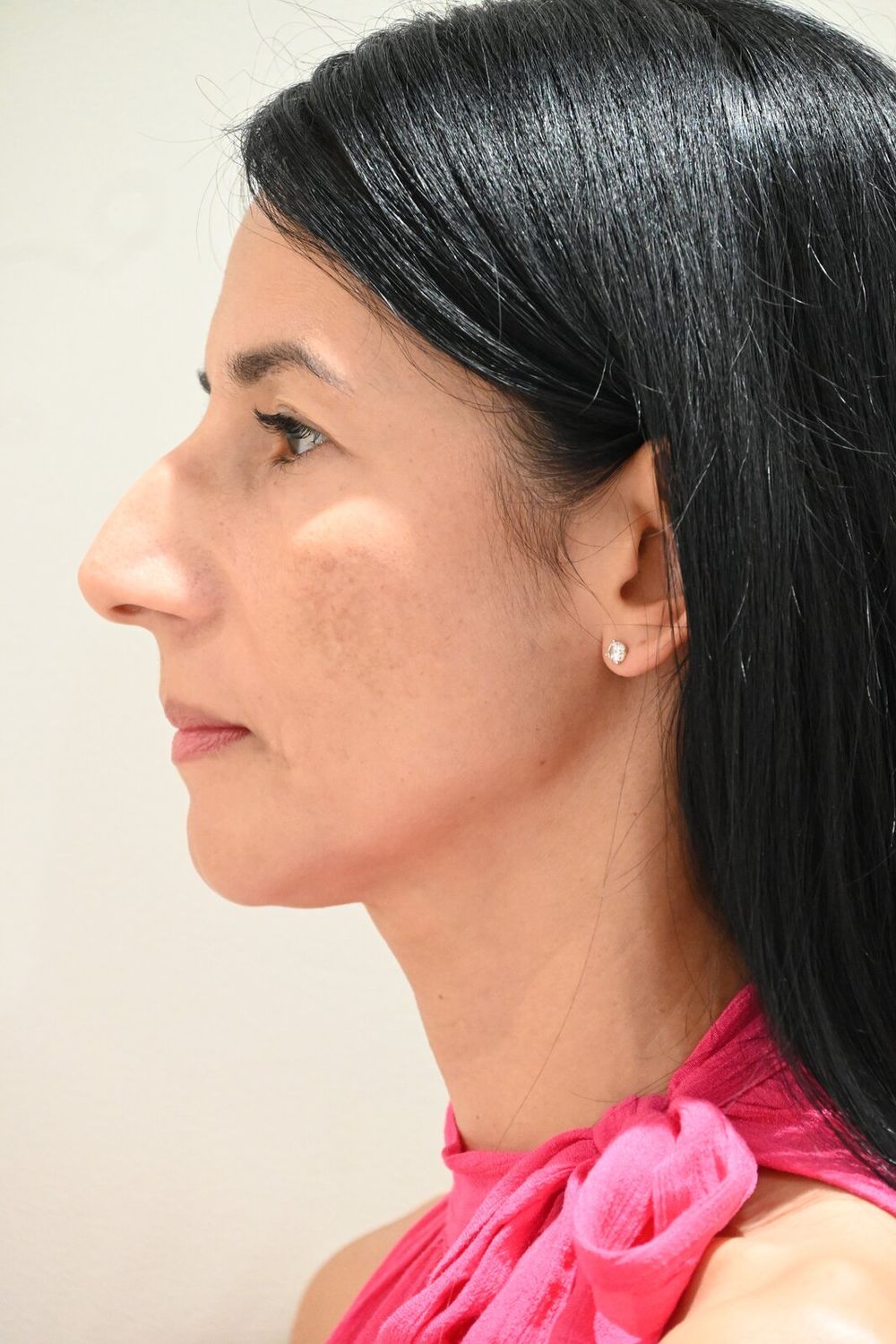 Rinoplastia Before & After