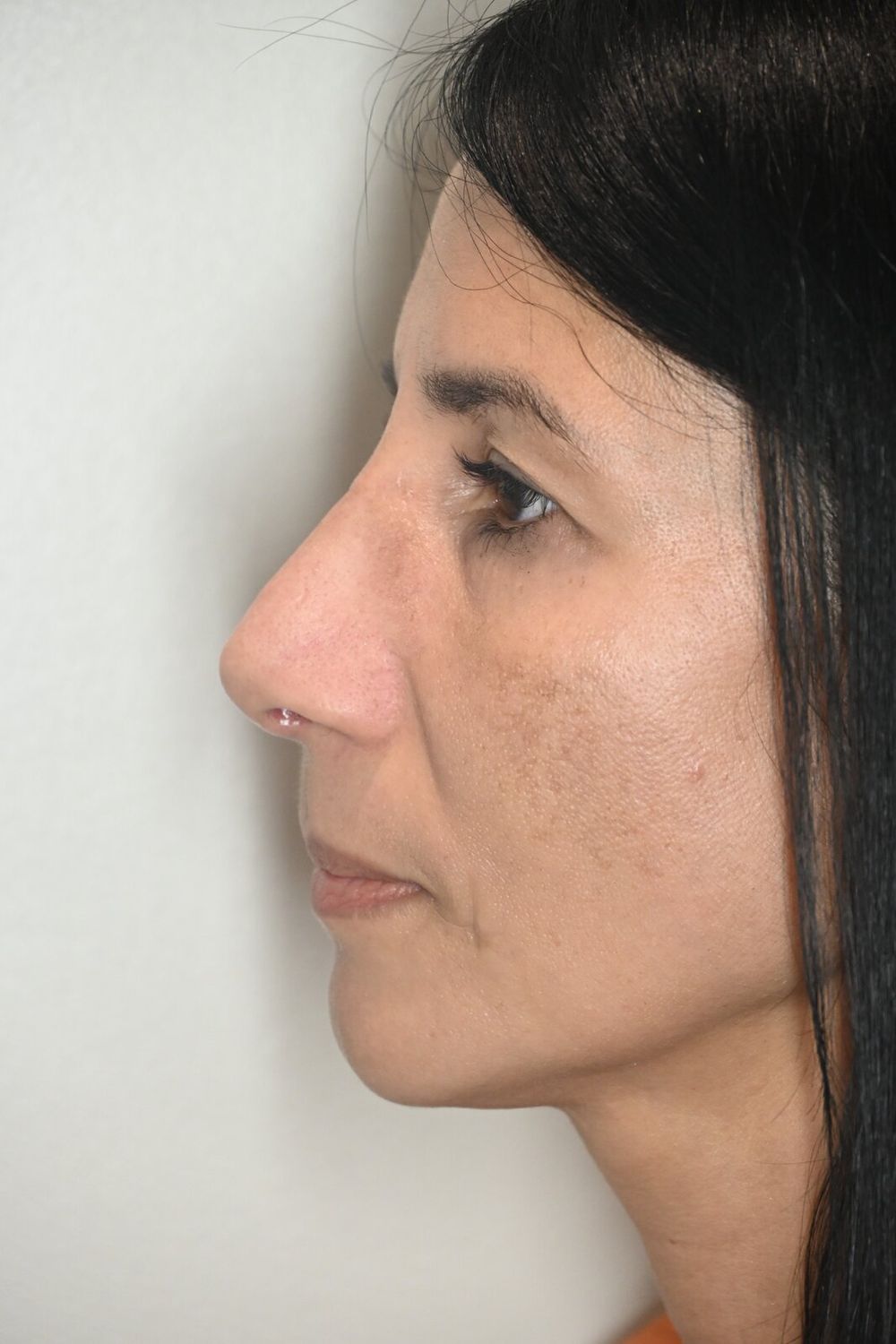 Rinoplastia Before & After