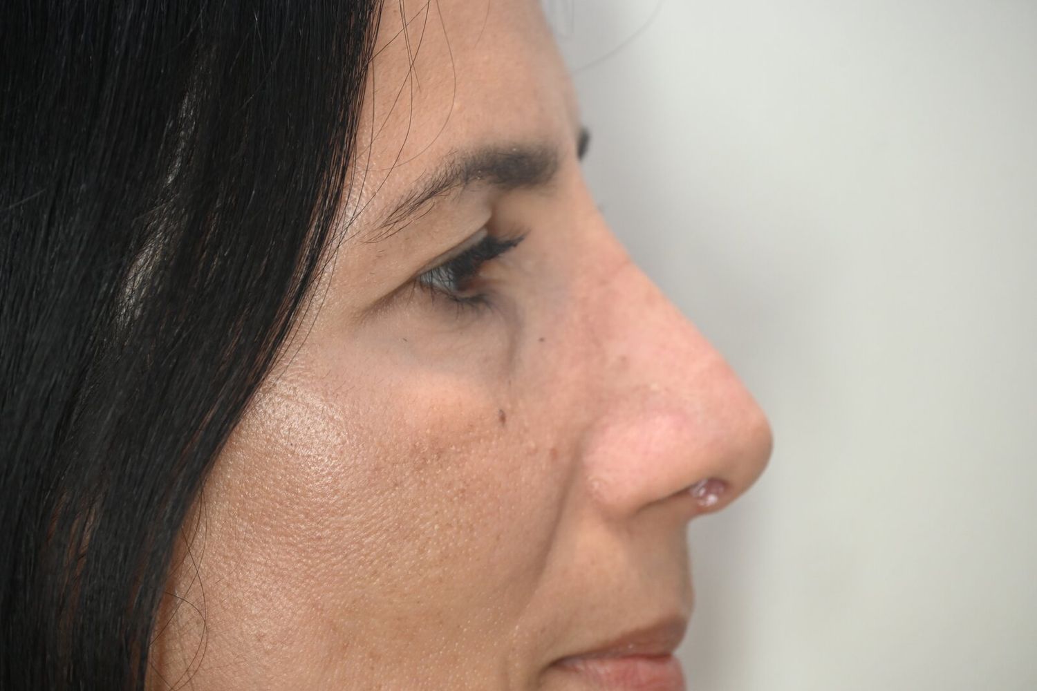 Rinoplastia Before & After