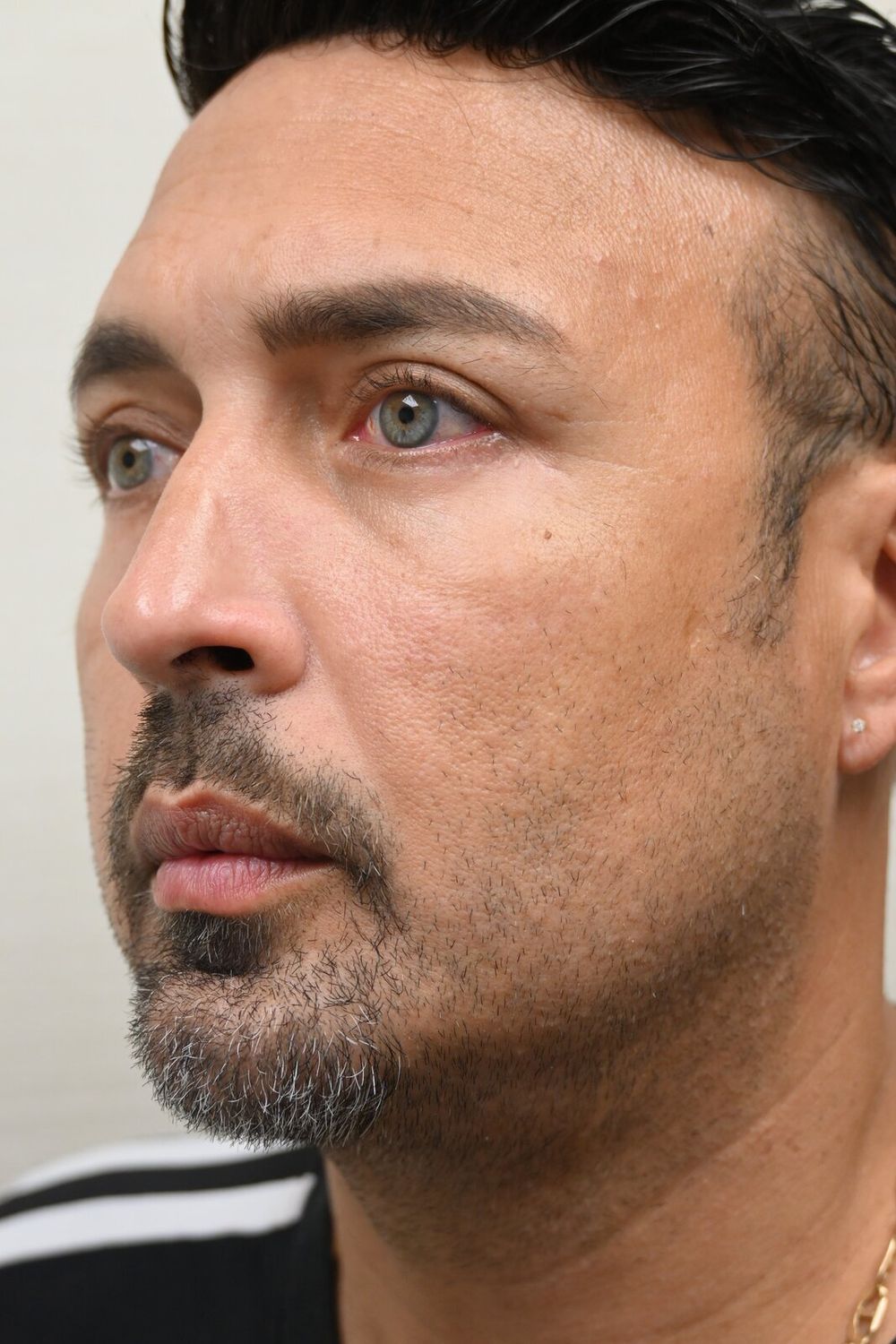 Rinoplastia Before & After