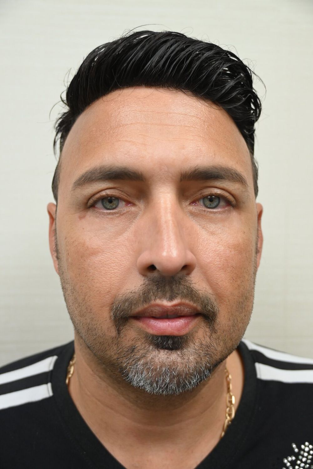 Rinoplastia Before & After