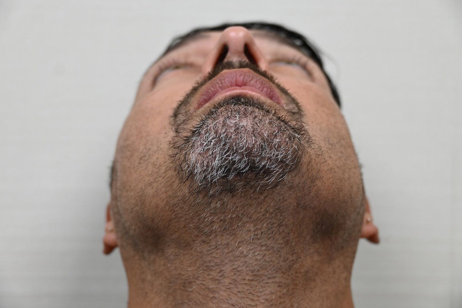 Rinoplastia Before & After