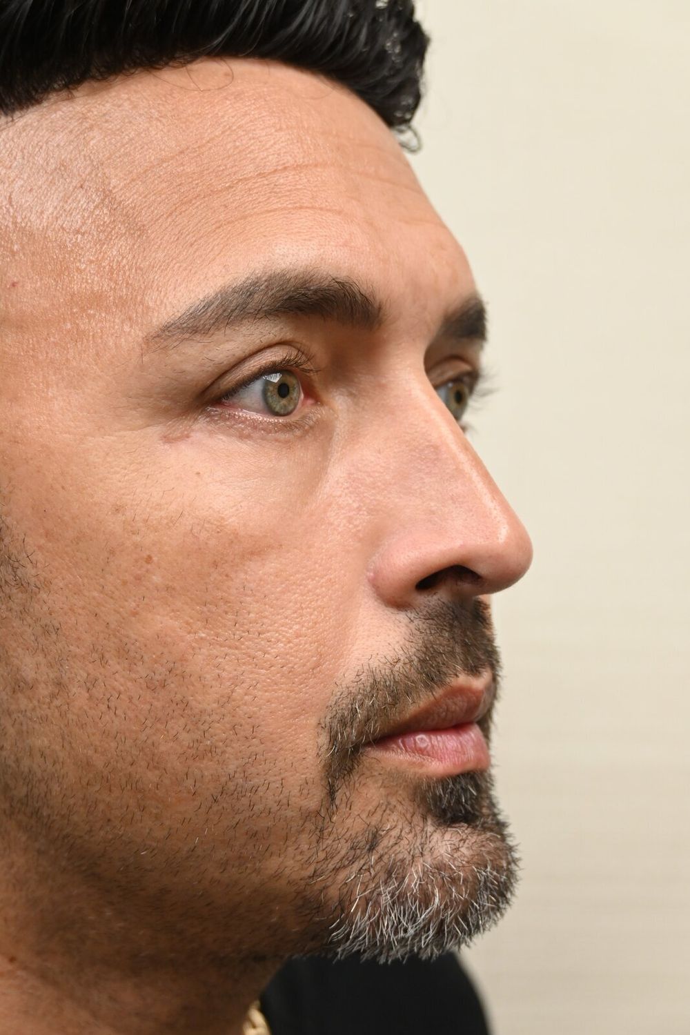 Rinoplastia Before & After