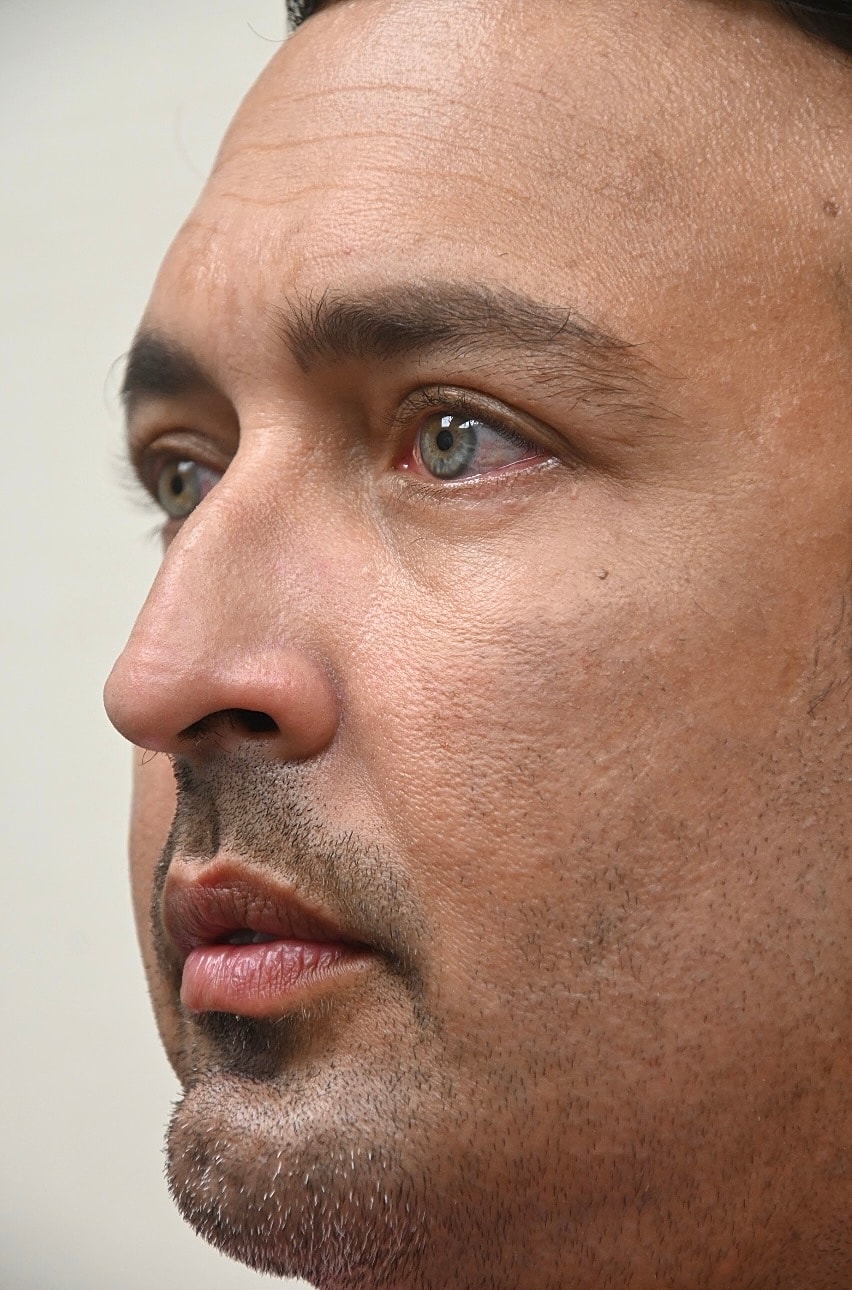 Rinoplastia Before & After