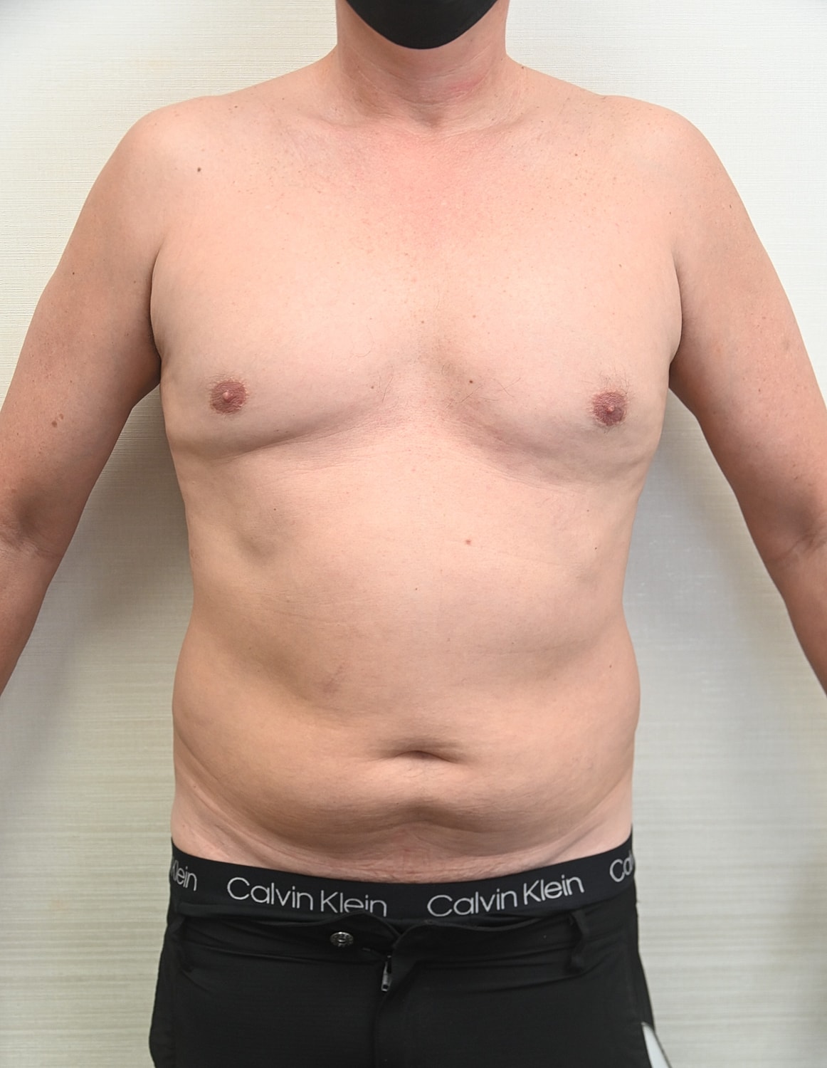 Liposuccion Abdomen Before & After