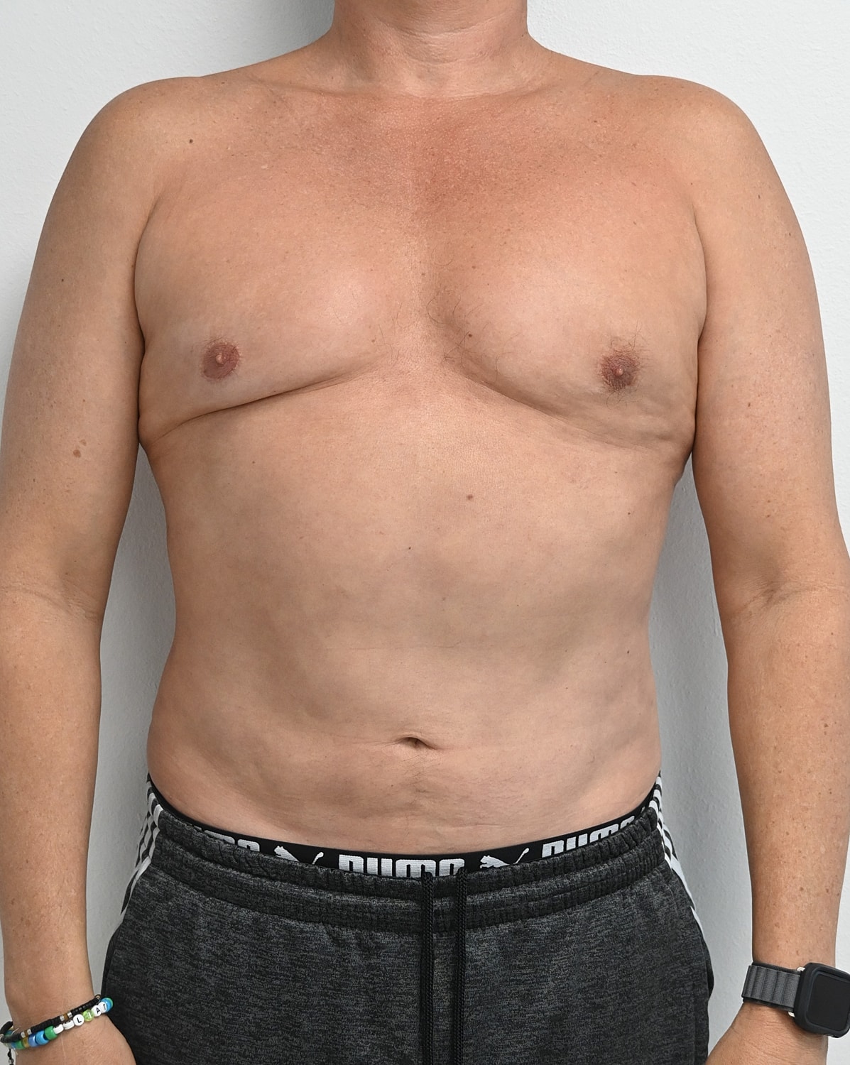 Liposuccion Abdomen Before & After
