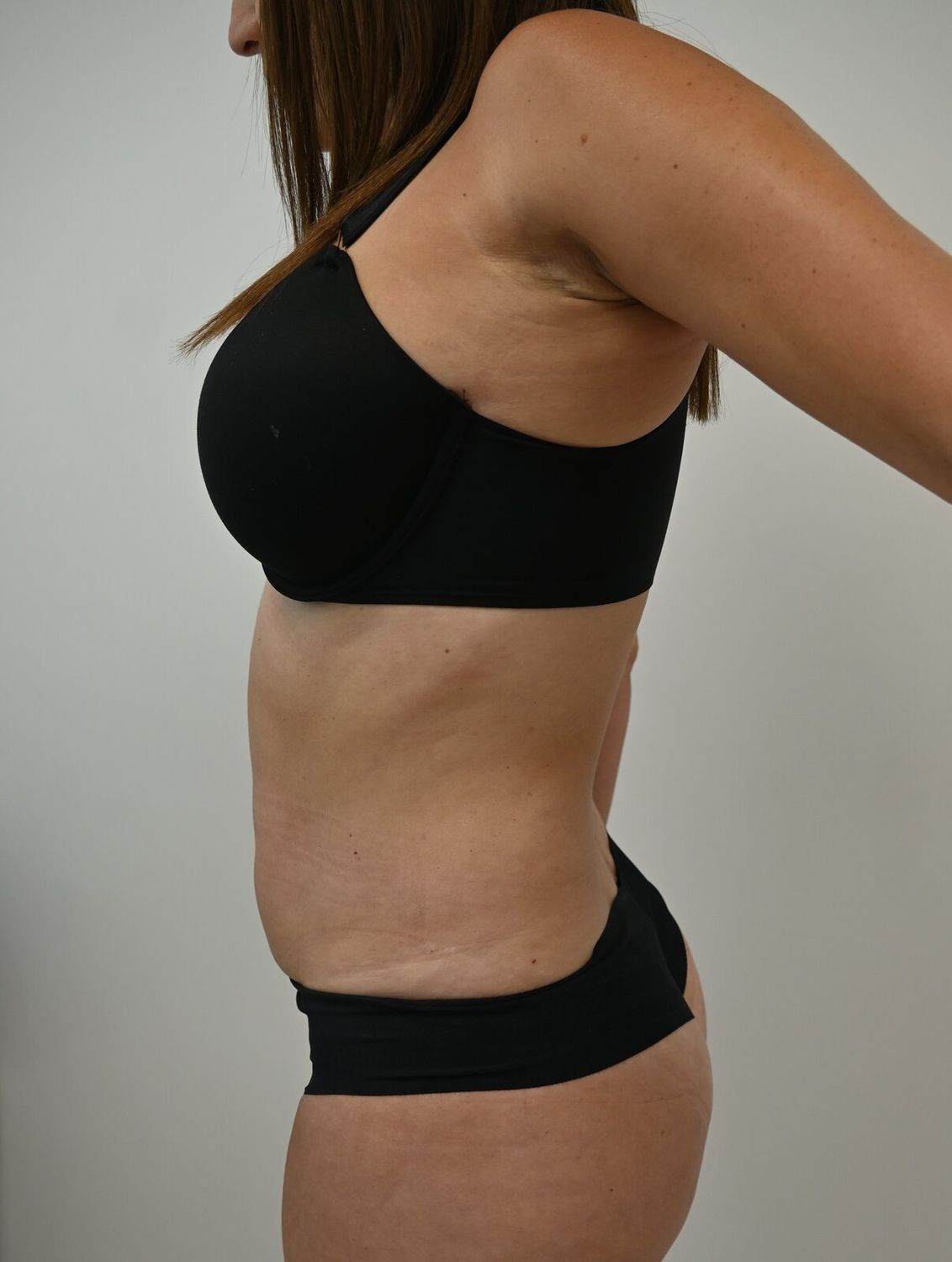 Liposuccion Abdomen Before & After