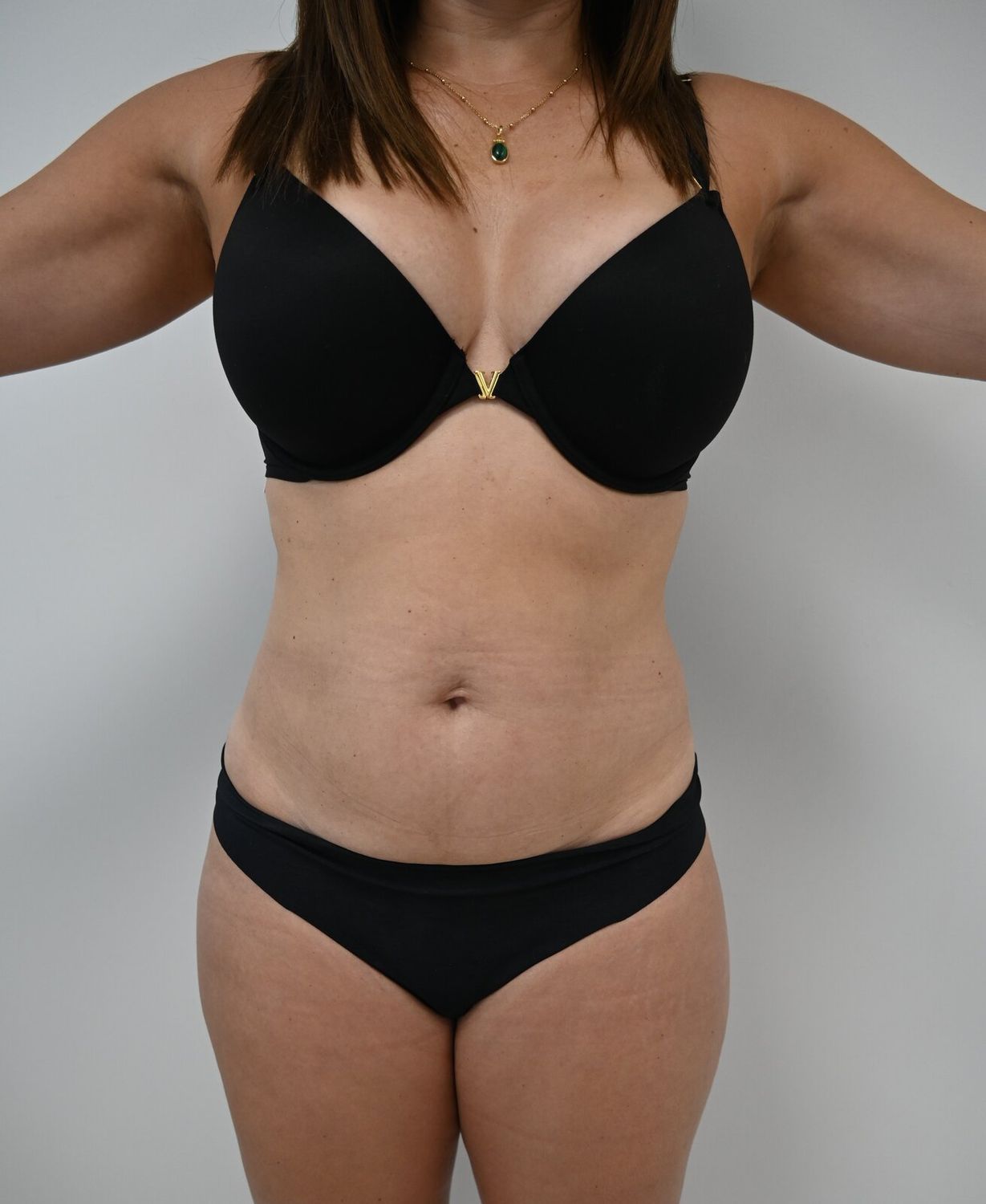 Liposuccion Abdomen Before & After