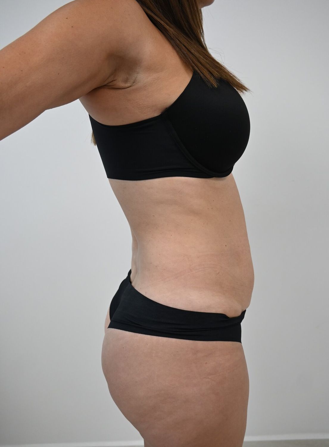Liposuccion Abdomen Before & After