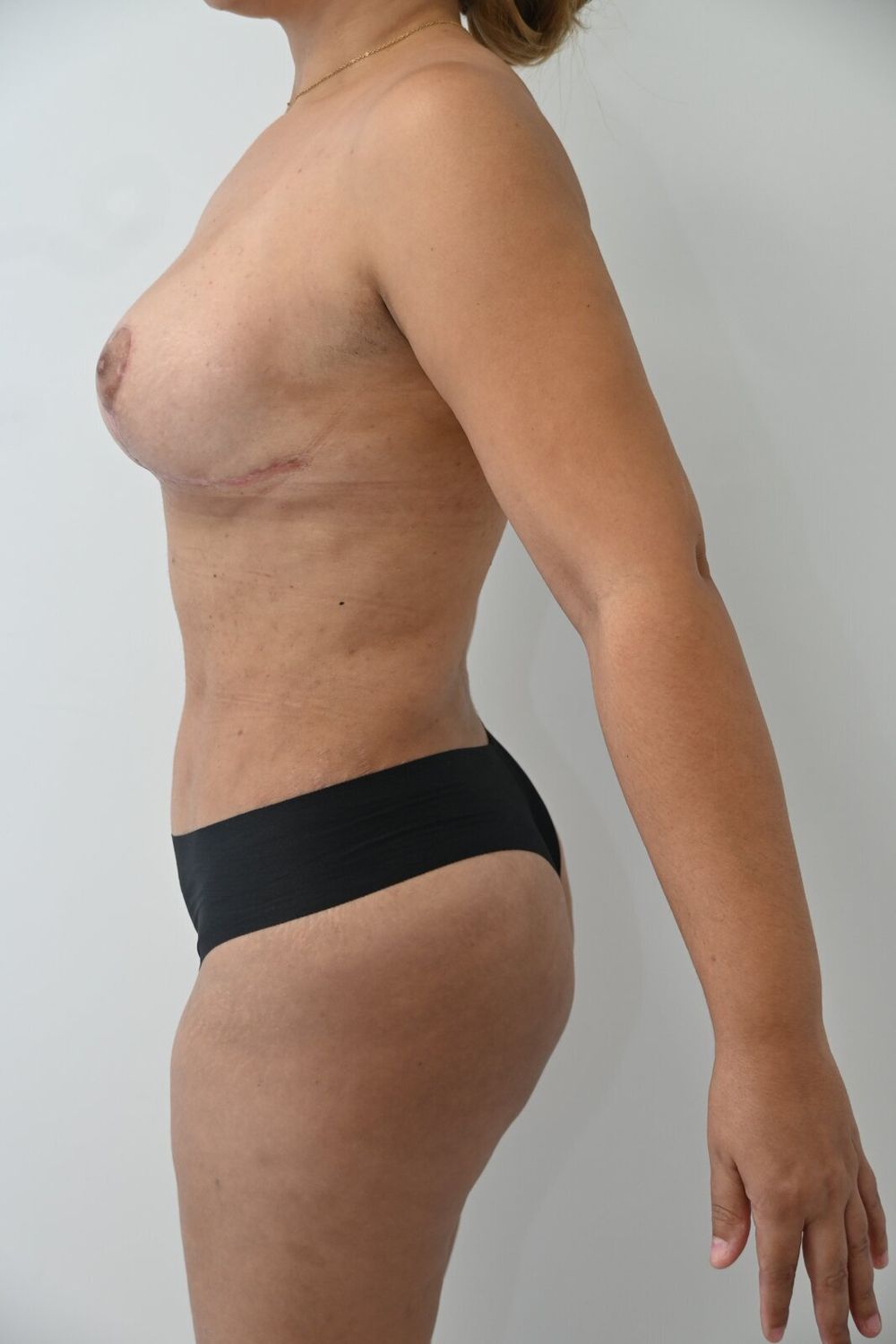 Liposuccion Abdomen Before & After