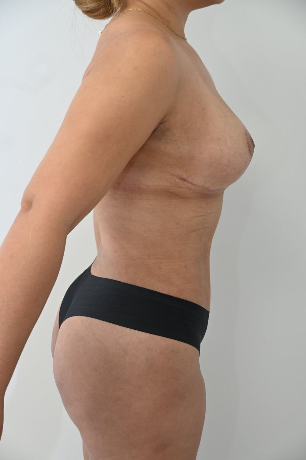 Liposuccion Abdomen Before & After