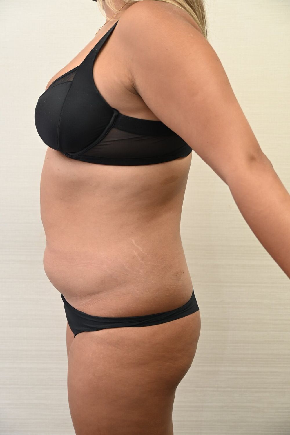Liposuccion Abdomen Before & After