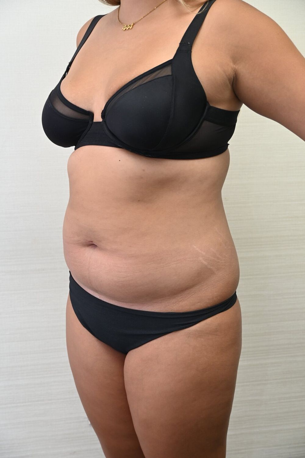 Liposuccion Abdomen Before & After