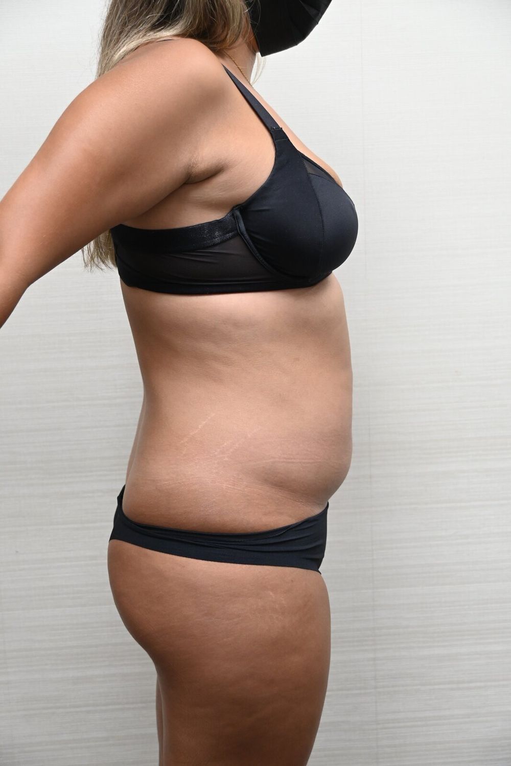 Liposuccion Abdomen Before & After