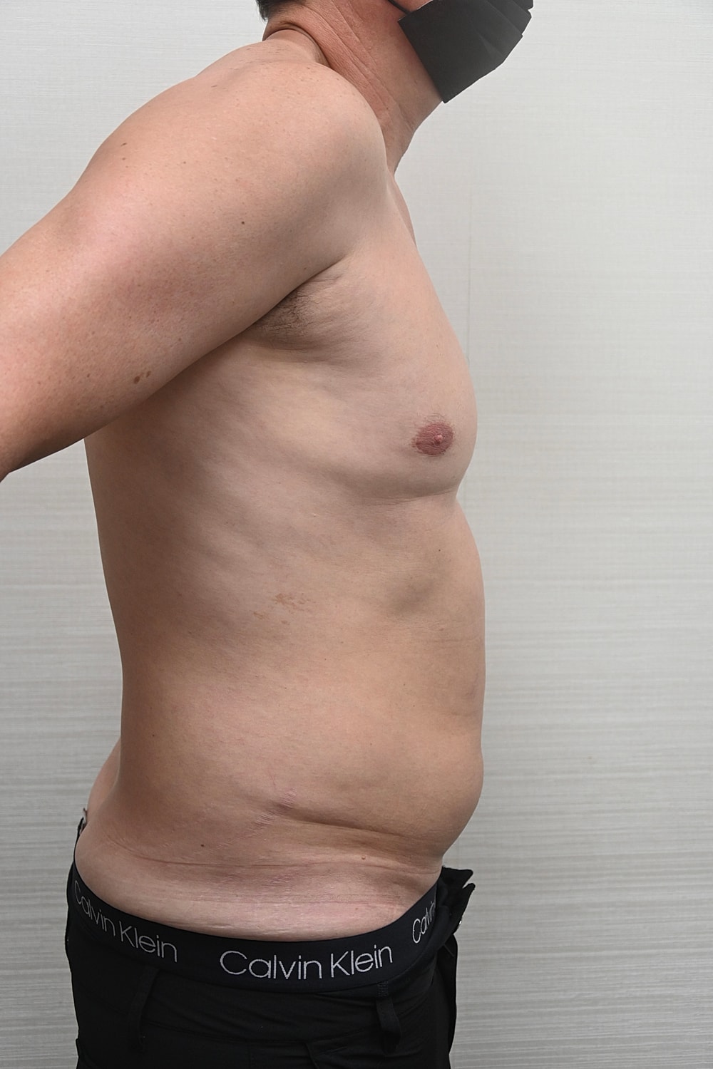 Liposuccion Abdomen Before & After