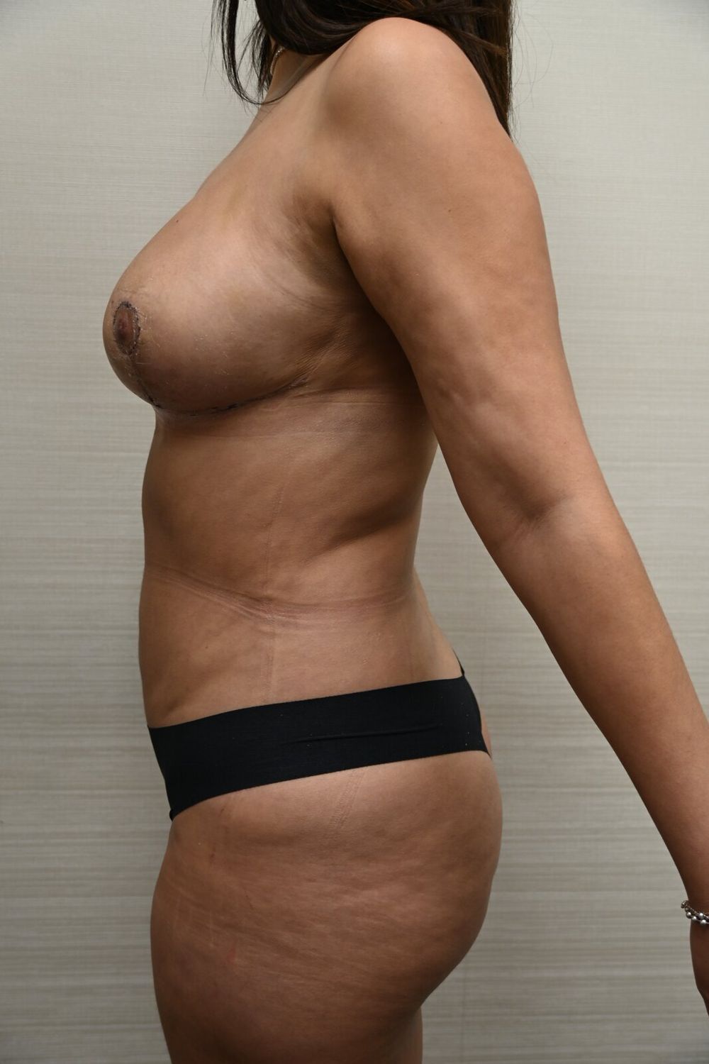 Liposuccion Abdomen Before & After