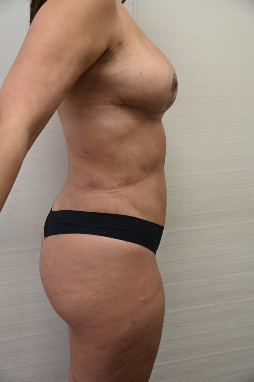 Liposuccion Abdomen Before & After