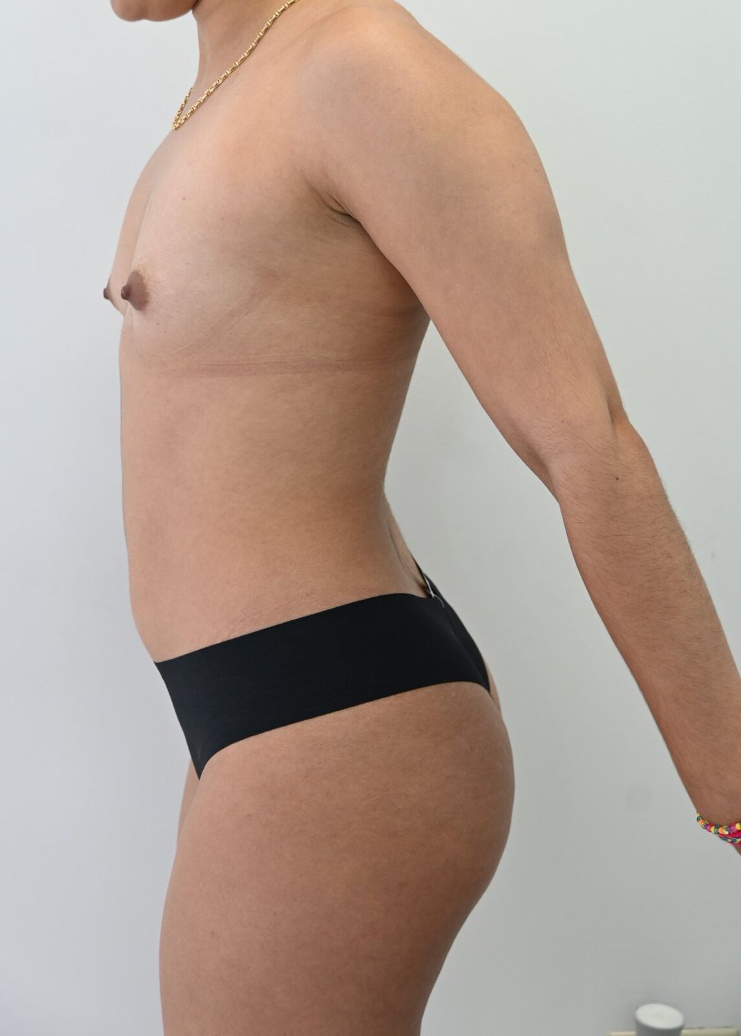 Liposuccion Abdomen Before & After