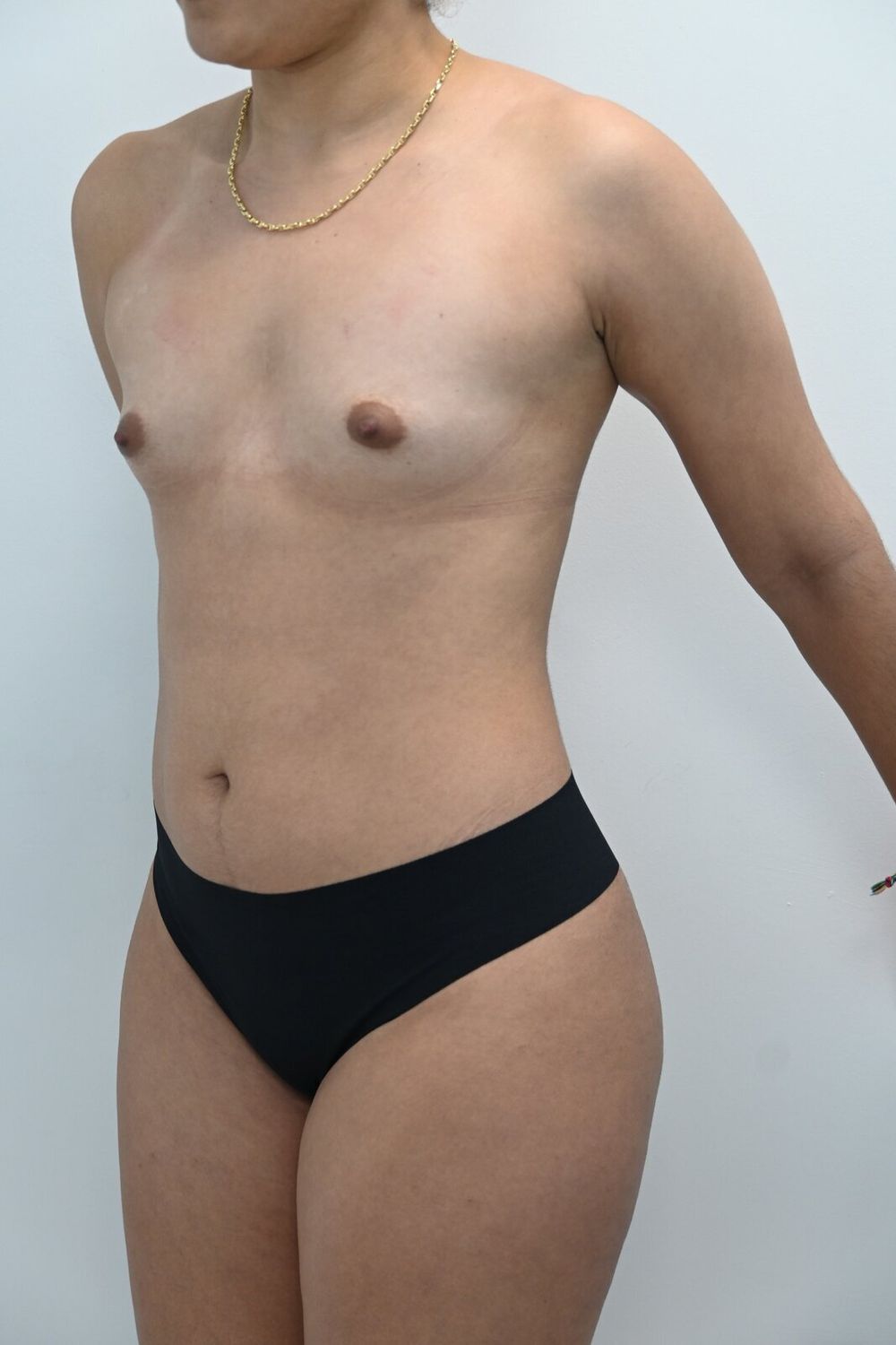 Liposuccion Abdomen Before & After