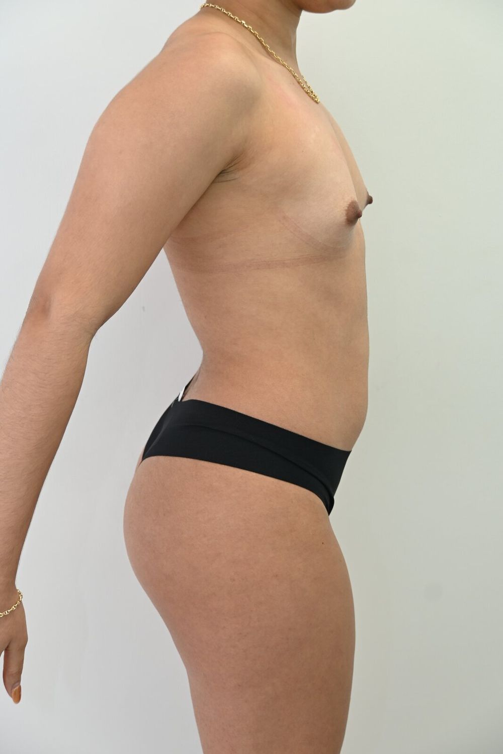 Liposuccion Abdomen Before & After