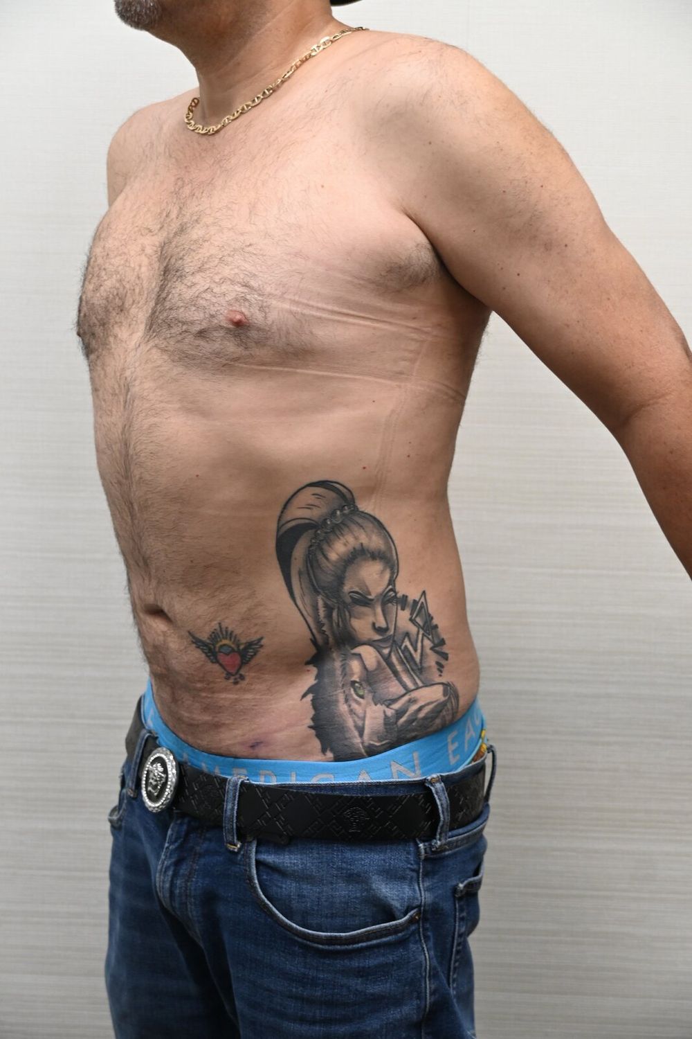 Liposuccion Abdomen Before & After