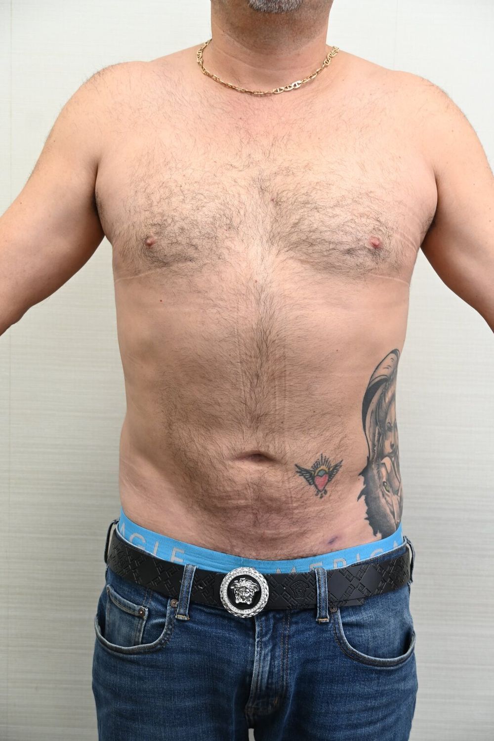 Liposuccion Abdomen Before & After