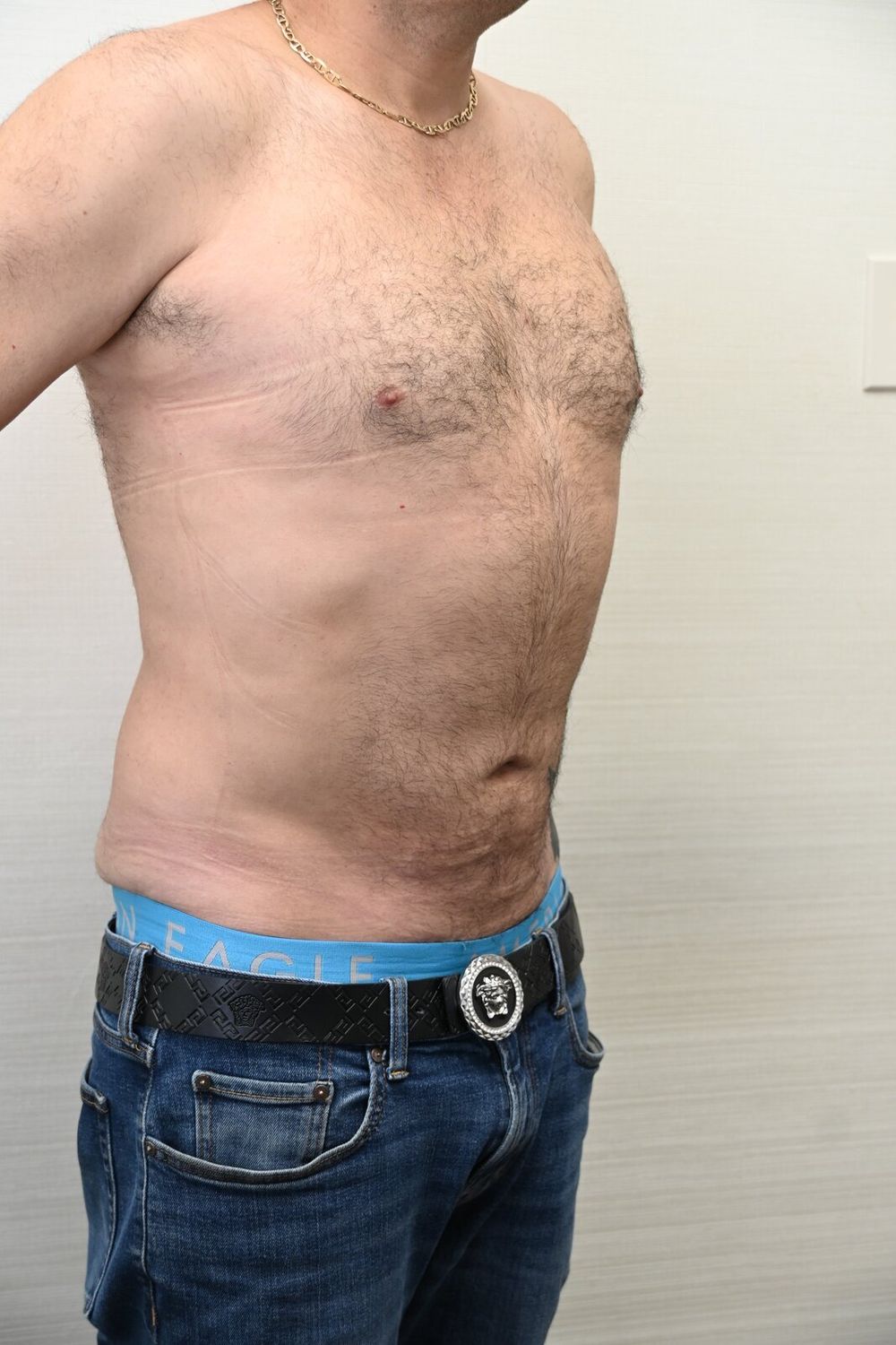 Liposuccion Abdomen Before & After