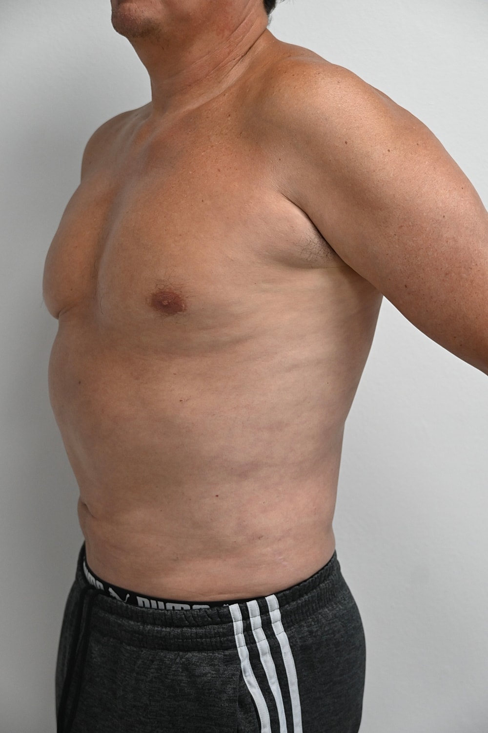 Liposuccion Abdomen Before & After
