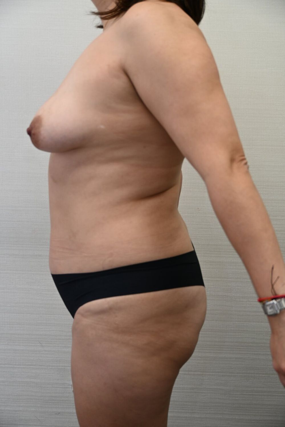 Liposuccion Abdomen Before & After