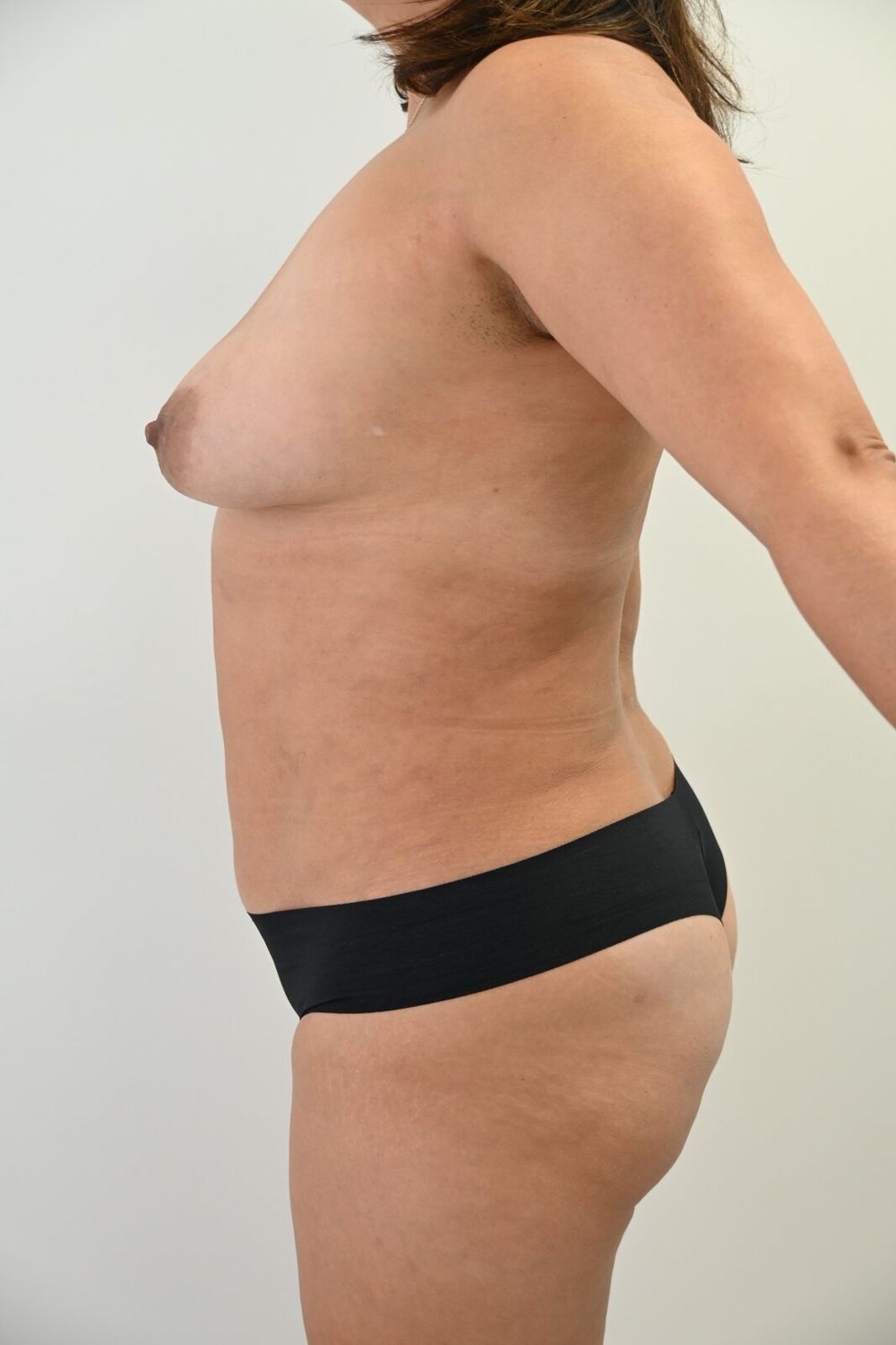 Liposuccion Abdomen Before & After