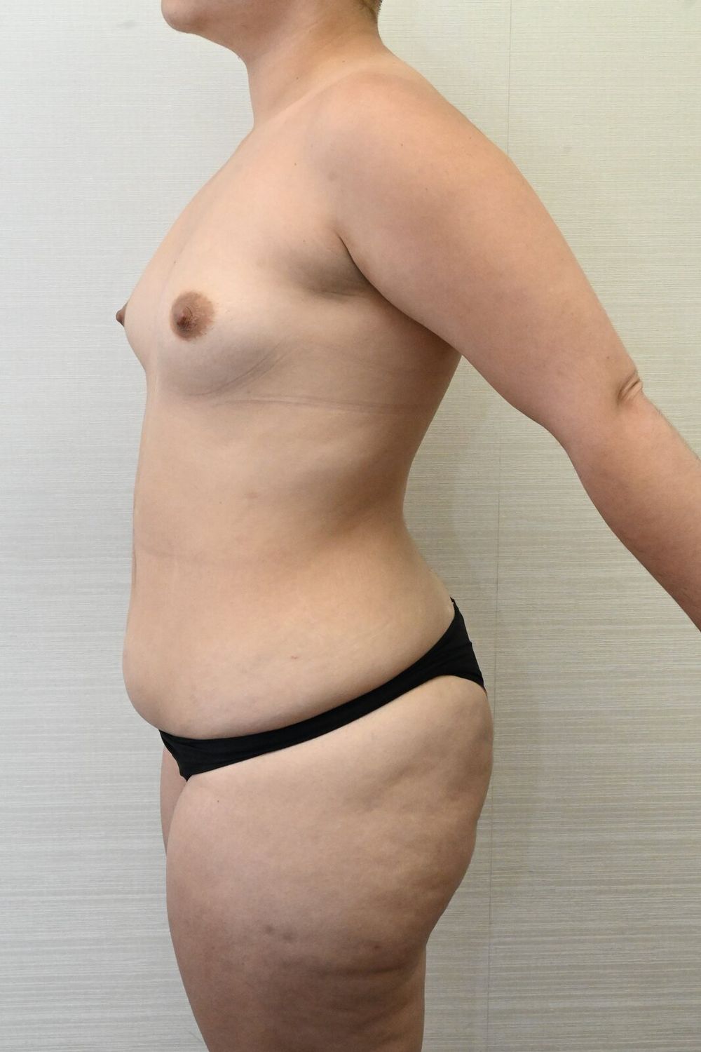 Liposuccion Abdomen Before & After