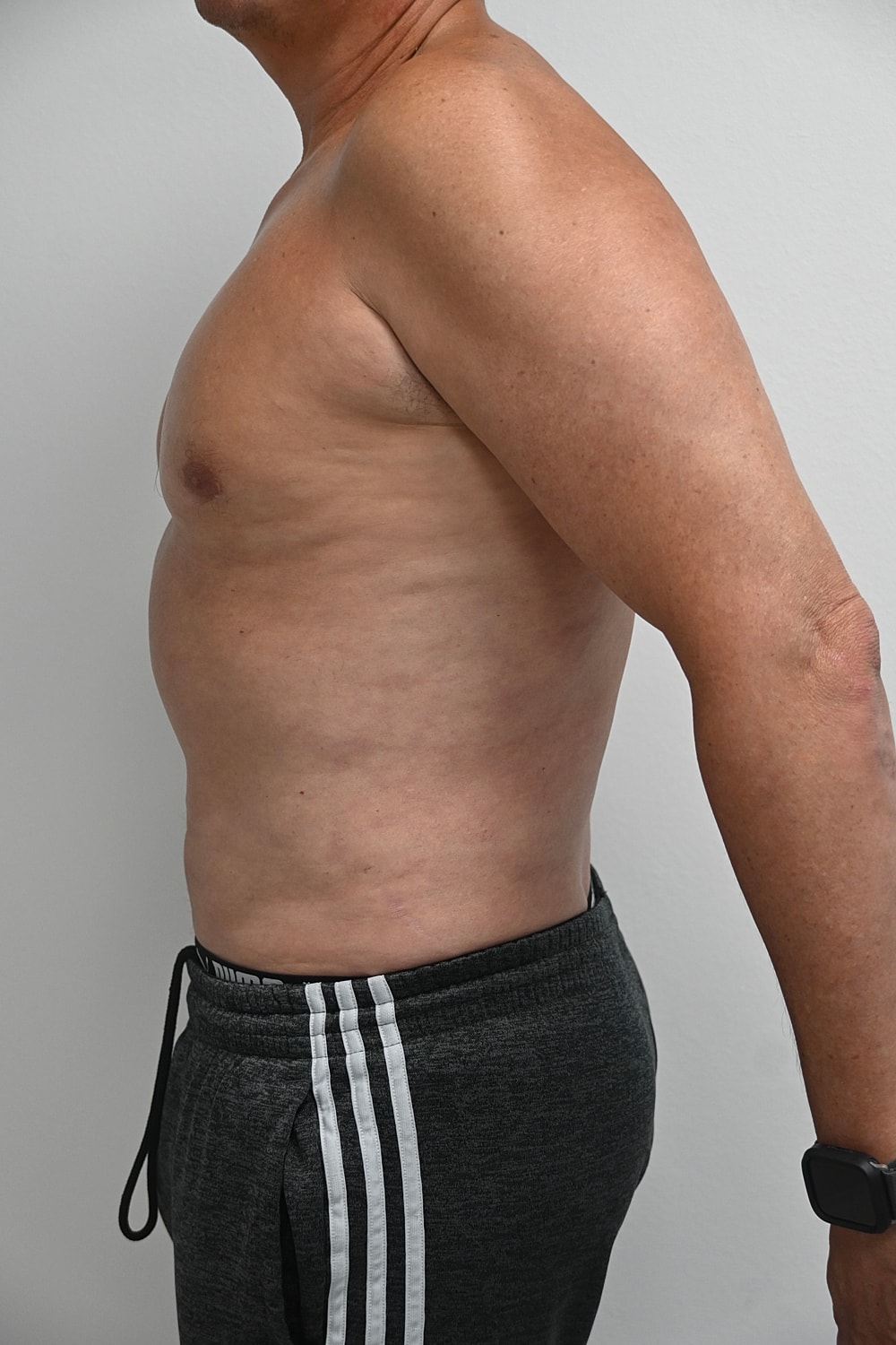Liposuccion Abdomen Before & After