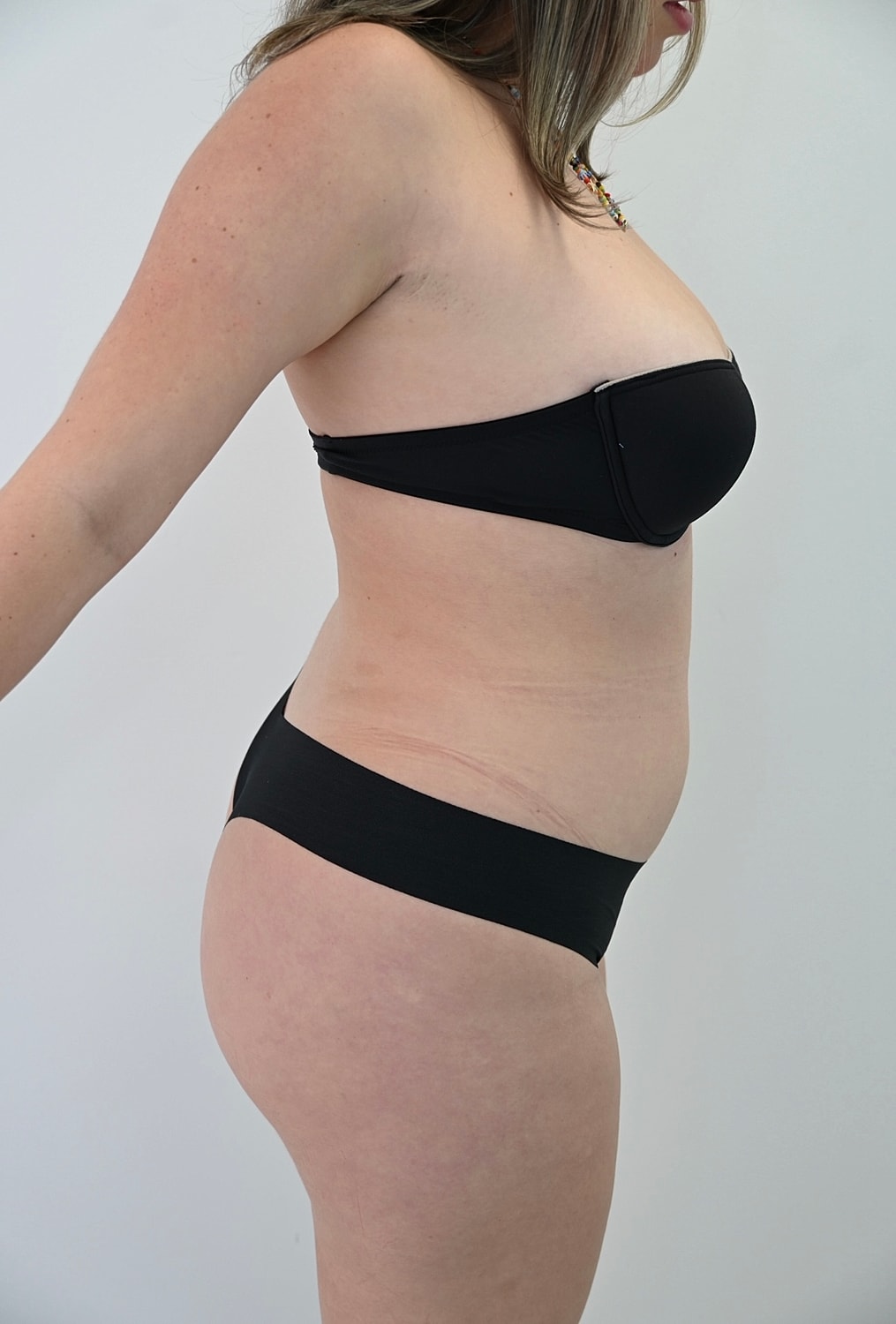 Liposuccion Abdomen Before & After