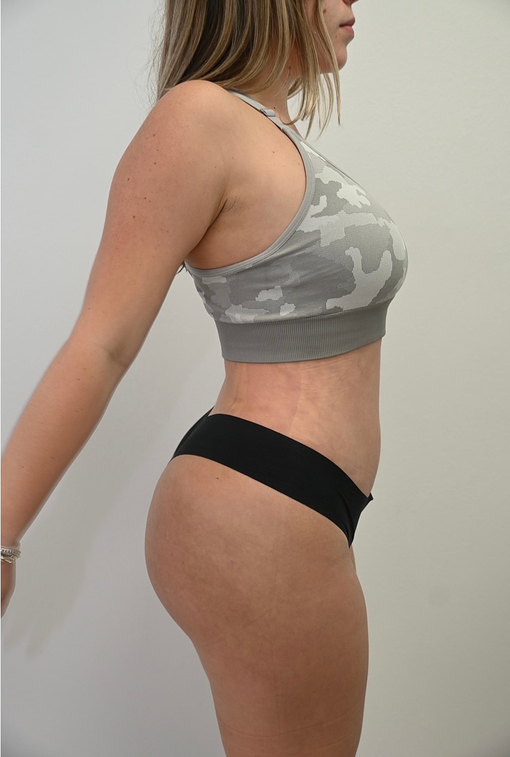 Liposuccion Abdomen Before & After