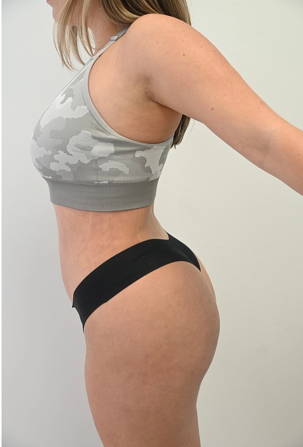 Liposuccion Abdomen Before & After