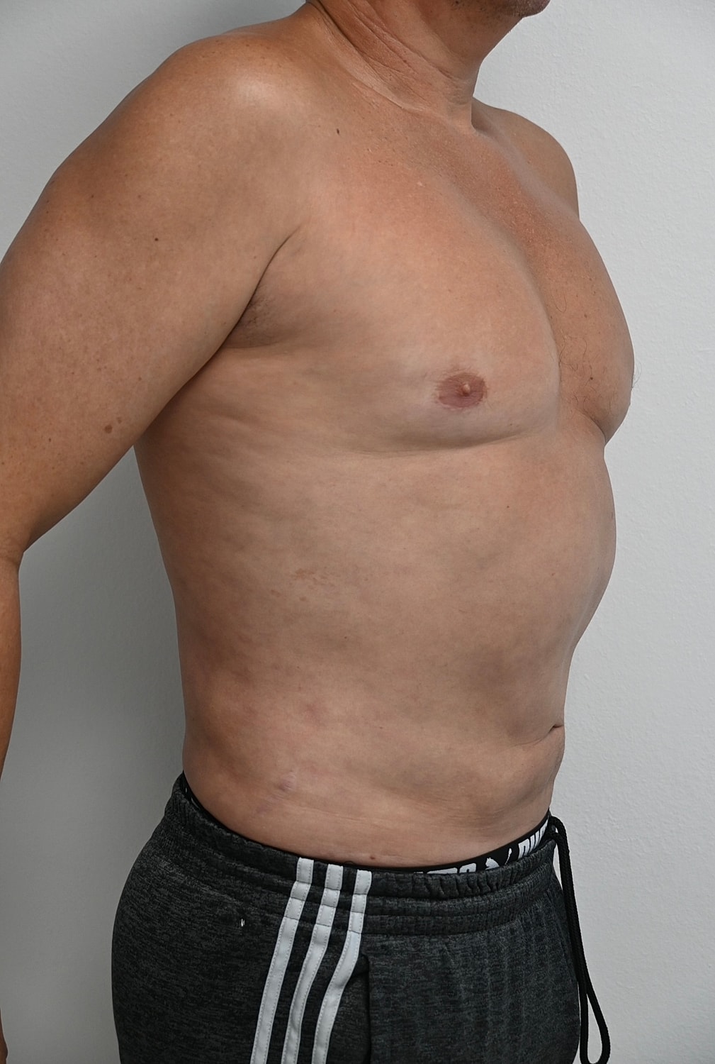 Liposuccion Abdomen Before & After