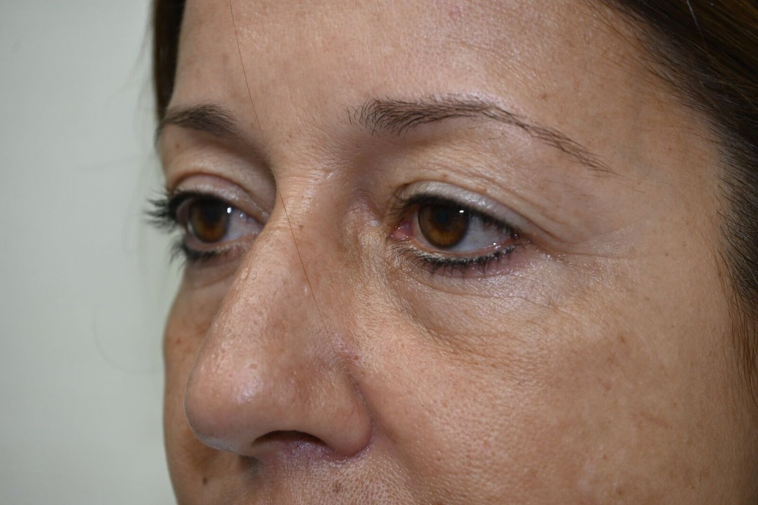 Blefaroplastia Before & After