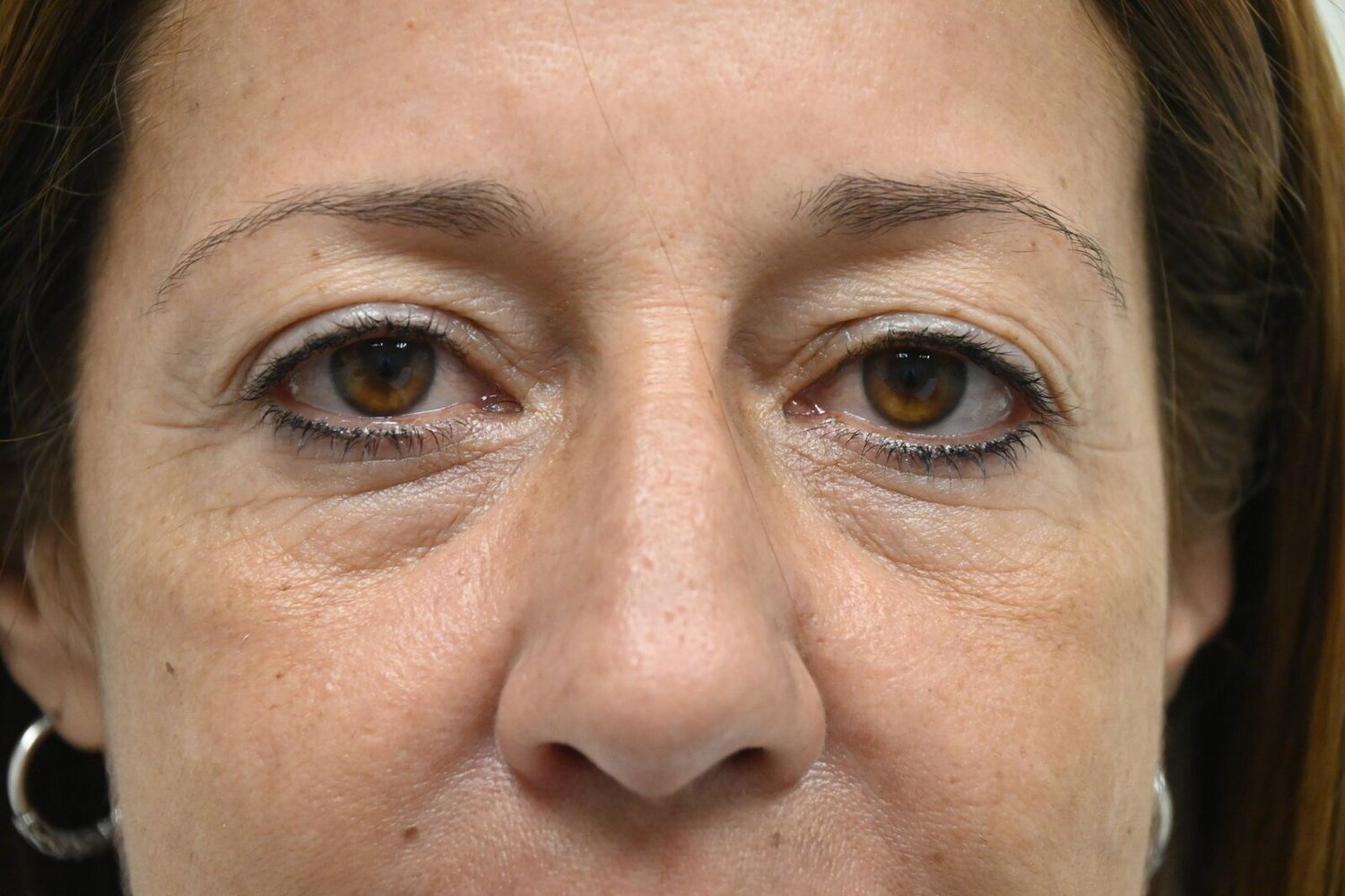 Blefaroplastia Before & After