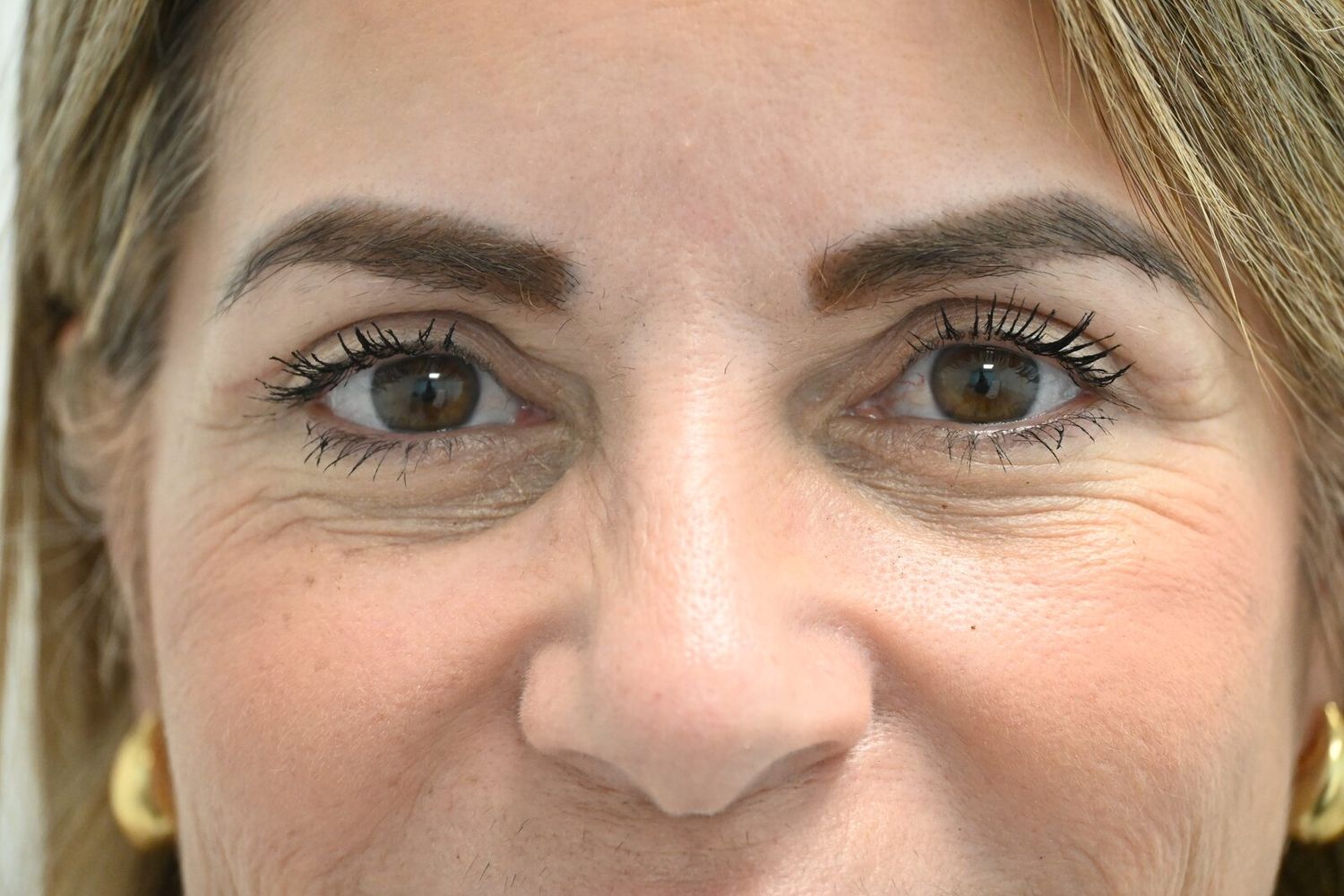 Blefaroplastia Before & After