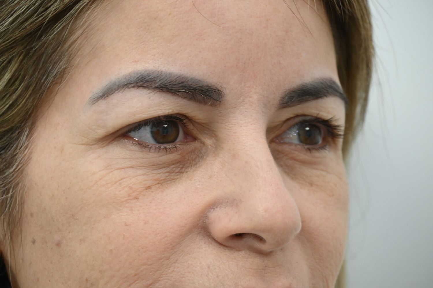 Blefaroplastia Before & After