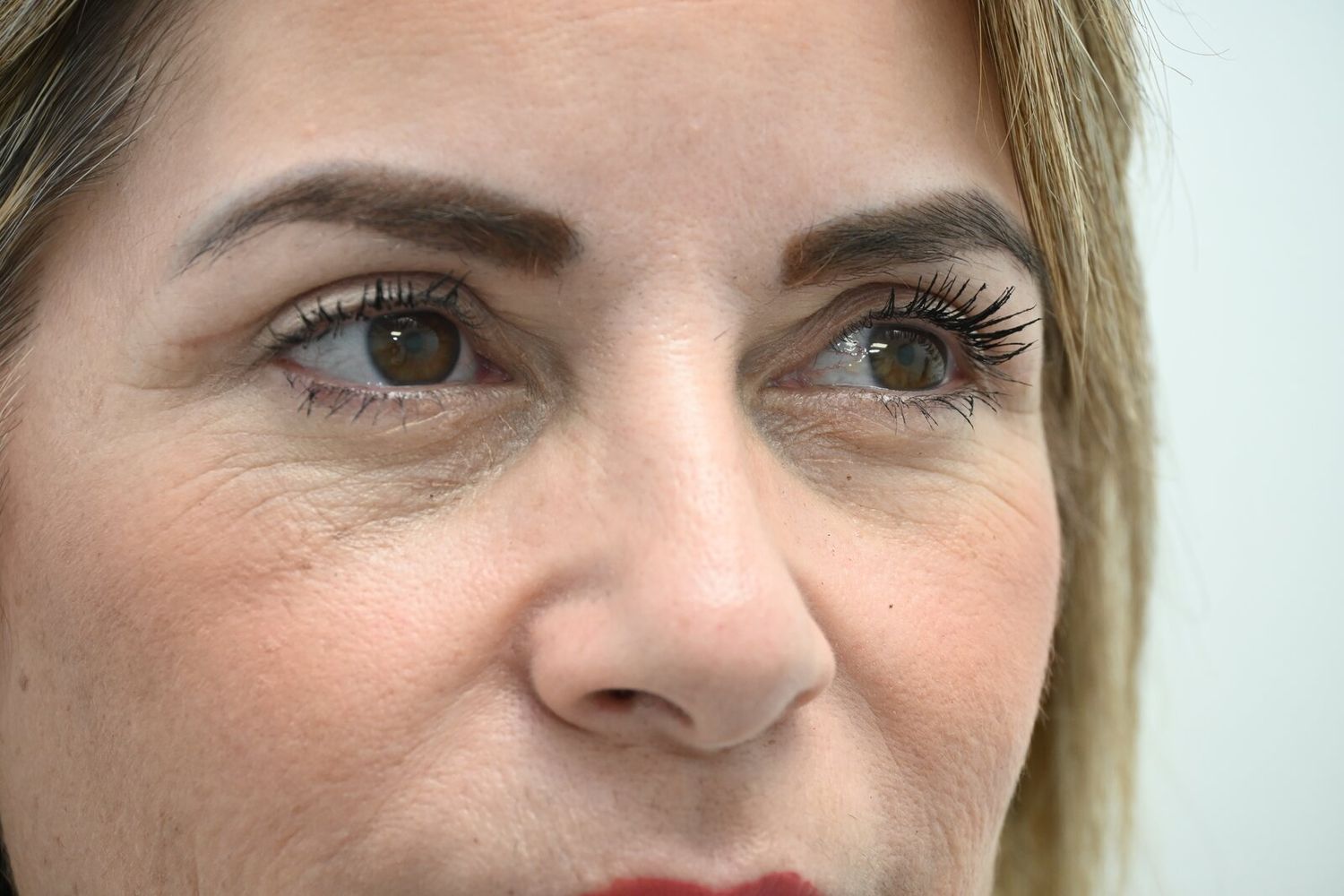 Blefaroplastia Before & After