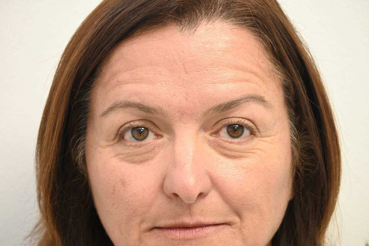 Blefaroplastia Before & After