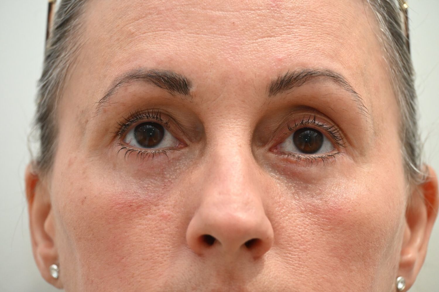 Blefaroplastia Before & After