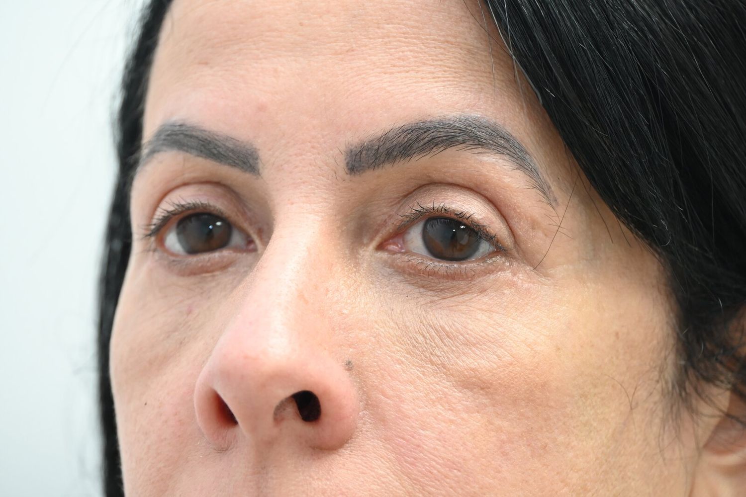 Blefaroplastia Before & After