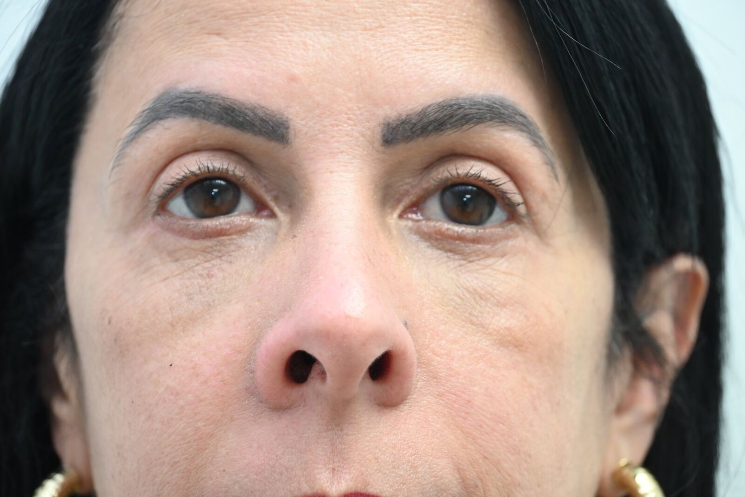 Blefaroplastia Before & After
