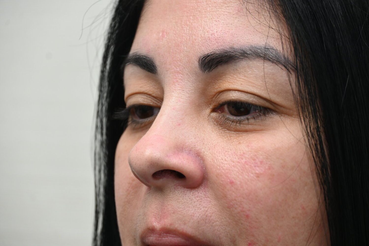 Blefaroplastia Before & After